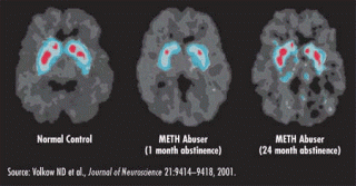 http://www.stopthedrugwar.org/files/methbrainscans.gif